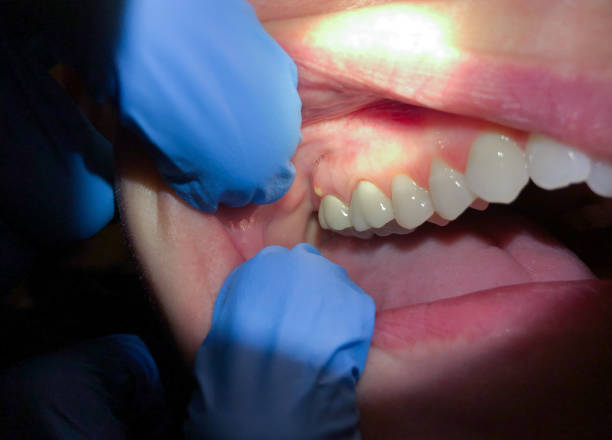 Best Emergency Gum Treatment in Orion, IL